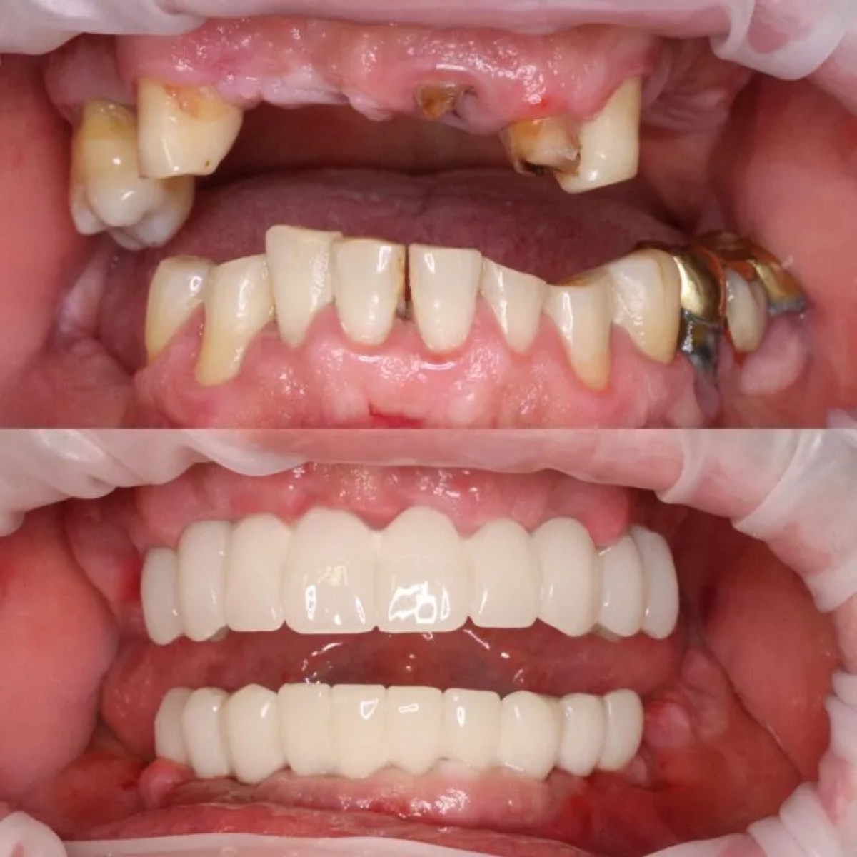 All-on-6 implant dentar, rezultat pacient diaspora UK Dr. Alexandru Tatu
